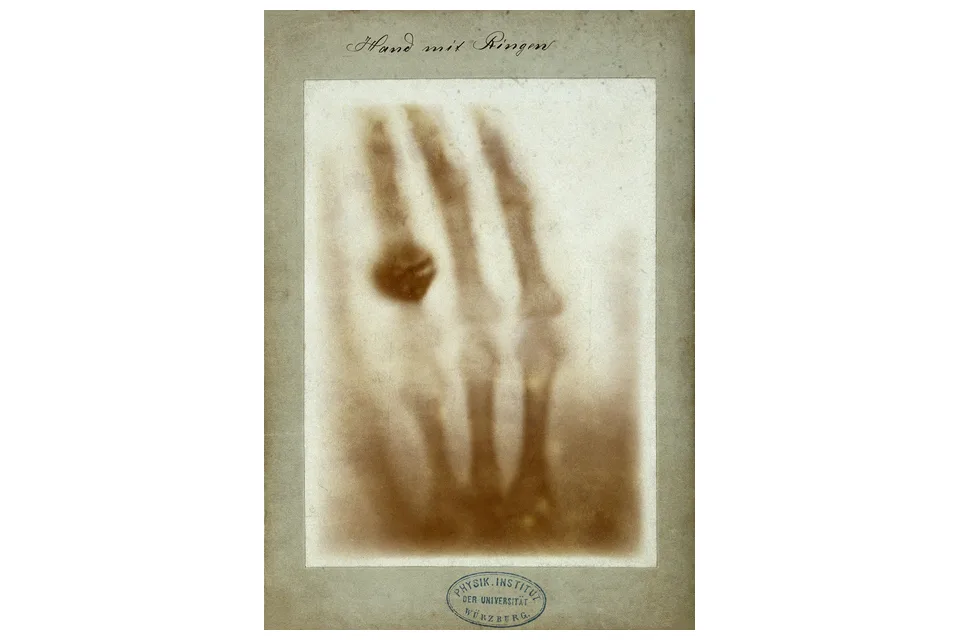 Первый рентгеновский снимок кисти, 1895 год